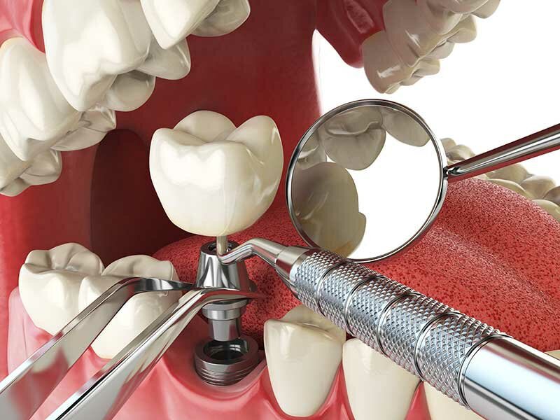 All-on-4 Dental Implants infographic