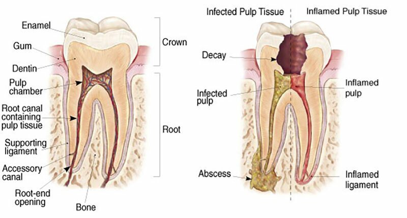 Tooth interior and infected pulp tissue diagram