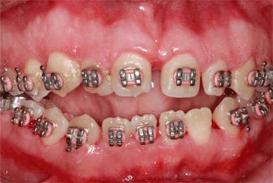 dental procedure after image